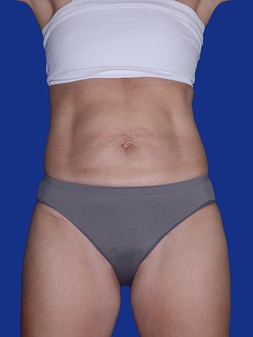 Body Lift Before & After
