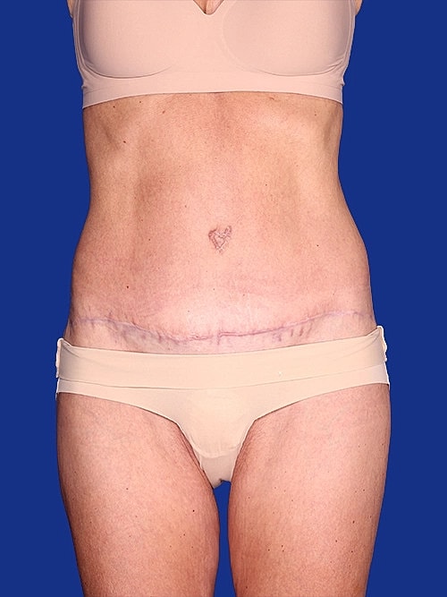 Body Lift Before & After