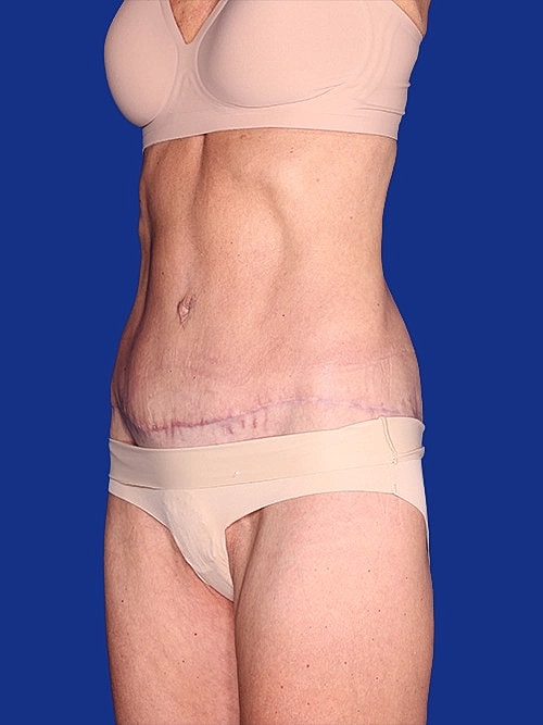 Body Lift Before & After