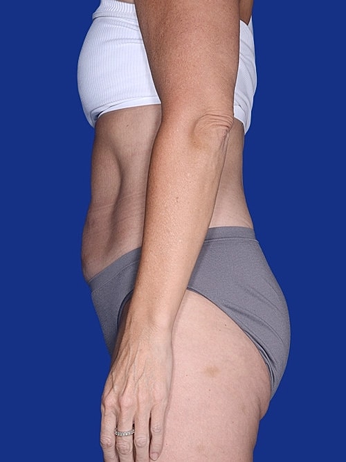 Body Lift Before & After