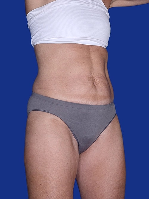 Body Lift Before & After