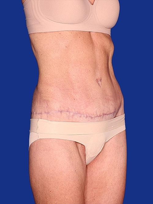 Body Lift Before & After
