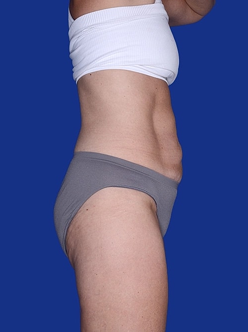 Body Lift Before & After