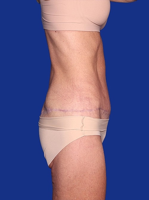 Body Lift Before & After