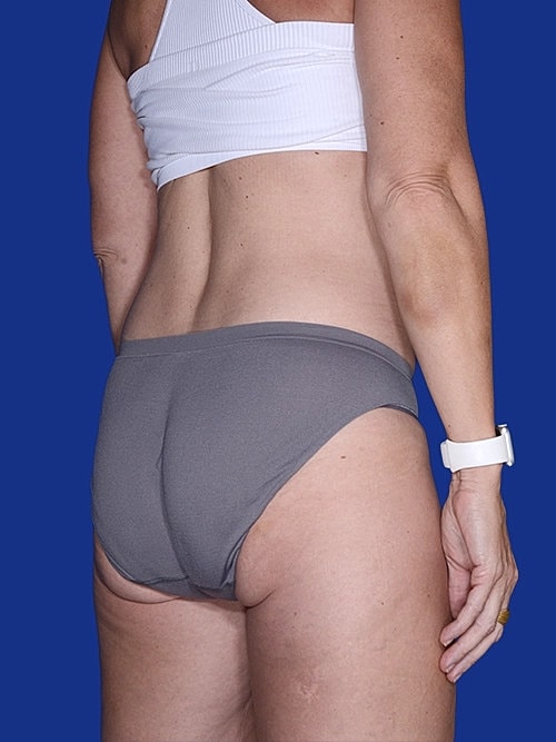 Body Lift Before & After