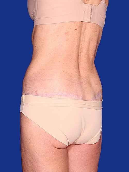 Body Lift Before & After