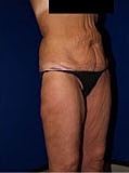 Body Lift Before & After