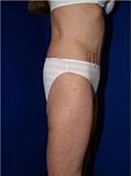 Body Lift Before & After