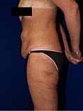 Body Lift Before & After