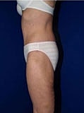 Body Lift Before & After