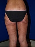 Body Lift Before & After