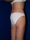 Body Lift Before & After
