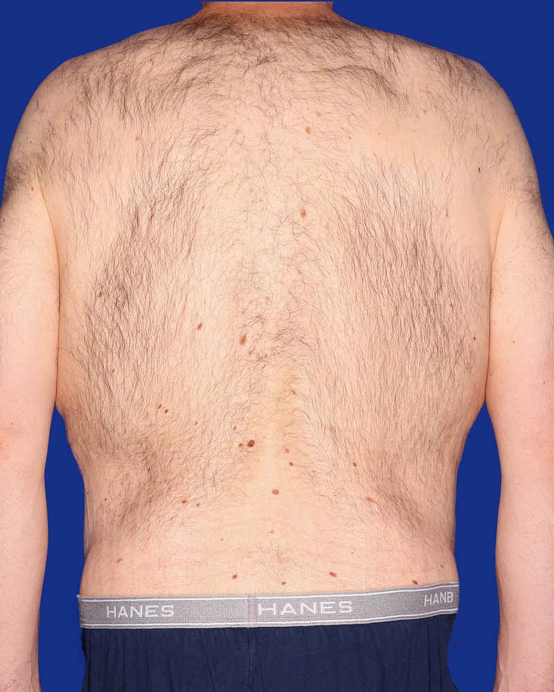 Body Lift Before & After