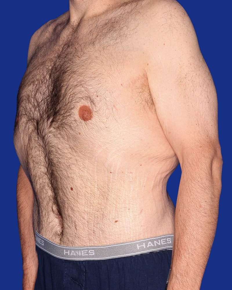 Body Lift Before & After