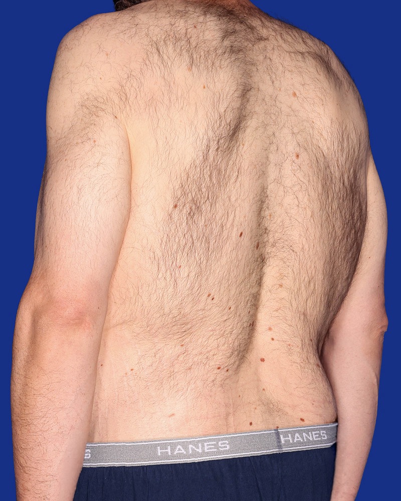 Body Lift Before & After