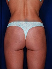 Body Lift Before & After