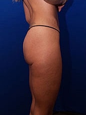 Body Lift Before & After