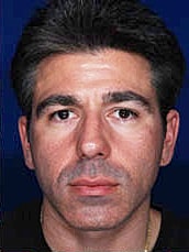 Male Rhinoplasty Before & After