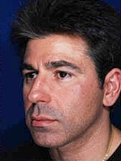Male Rhinoplasty Before & After