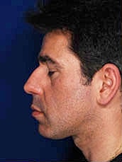 Male Rhinoplasty Before & After