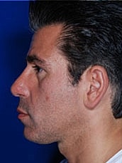 Male Rhinoplasty Before & After