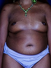Breast Fat Transfer Before & After