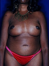 Breast Fat Transfer Before & After