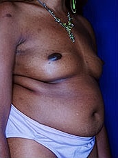 Breast Fat Transfer Before & After