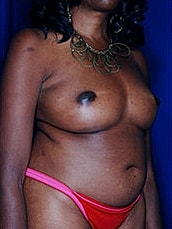 Breast Fat Transfer Before & After
