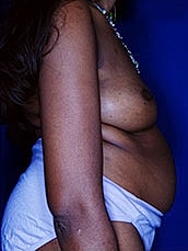 Breast Fat Transfer Before & After