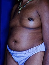 Breast Fat Transfer Before & After