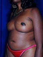 Breast Fat Transfer Before & After