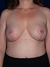 Breast Fat Transfer Before & After