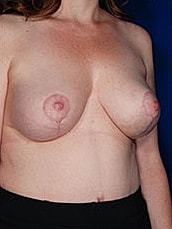 Breast Fat Transfer Before & After