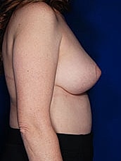 Breast Fat Transfer Before & After