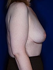 Breast Fat Transfer Before & After
