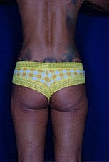 Brazilian Butt Lift Before & After
