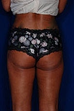 Brazilian Butt Lift Before & After