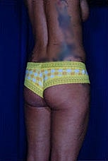 Brazilian Butt Lift Before & After