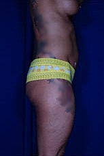 Brazilian Butt Lift Before & After