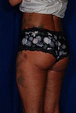 Brazilian Butt Lift Before & After