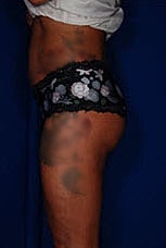 Brazilian Butt Lift Before & After