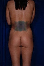 Brazilian Butt Lift Before & After