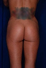 Brazilian Butt Lift Before & After