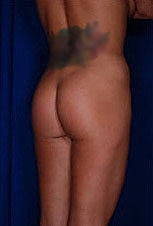 Brazilian Butt Lift Before & After