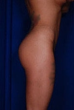 Brazilian Butt Lift Before & After