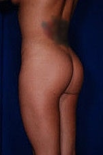 Brazilian Butt Lift Before & After