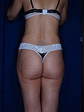 Brazilian Butt Lift Before & After