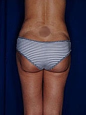 Brazilian Butt Lift Before & After