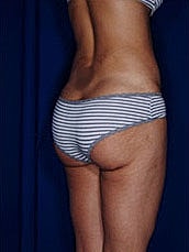 Brazilian Butt Lift Before & After